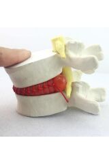 Disk Hernisi Fıtık Maketi Model 2